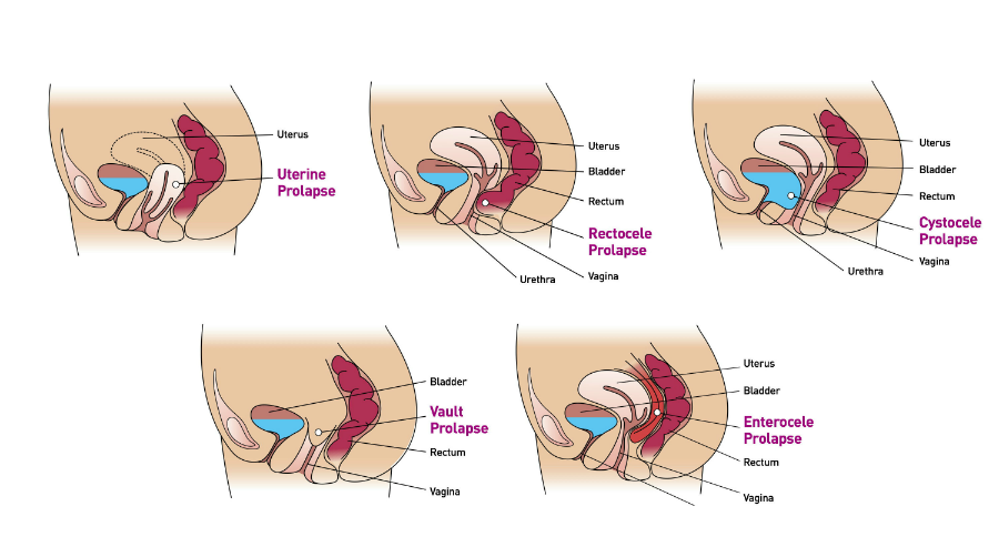 bladder prolapse sling