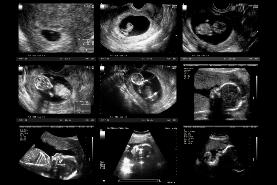Uterine Fibroids And Pregnancy